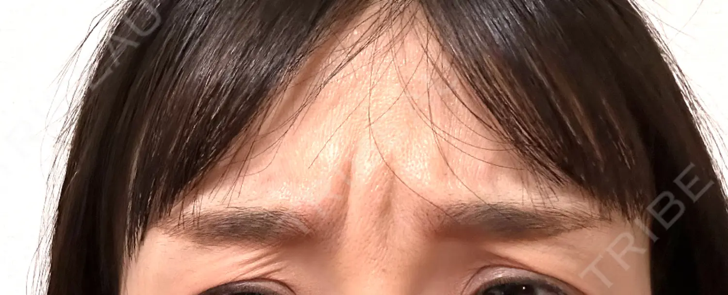 施術前の写真