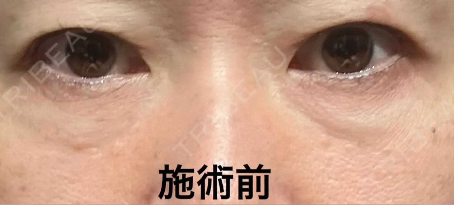施術前の写真