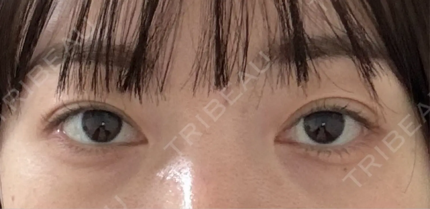 施術前の写真
