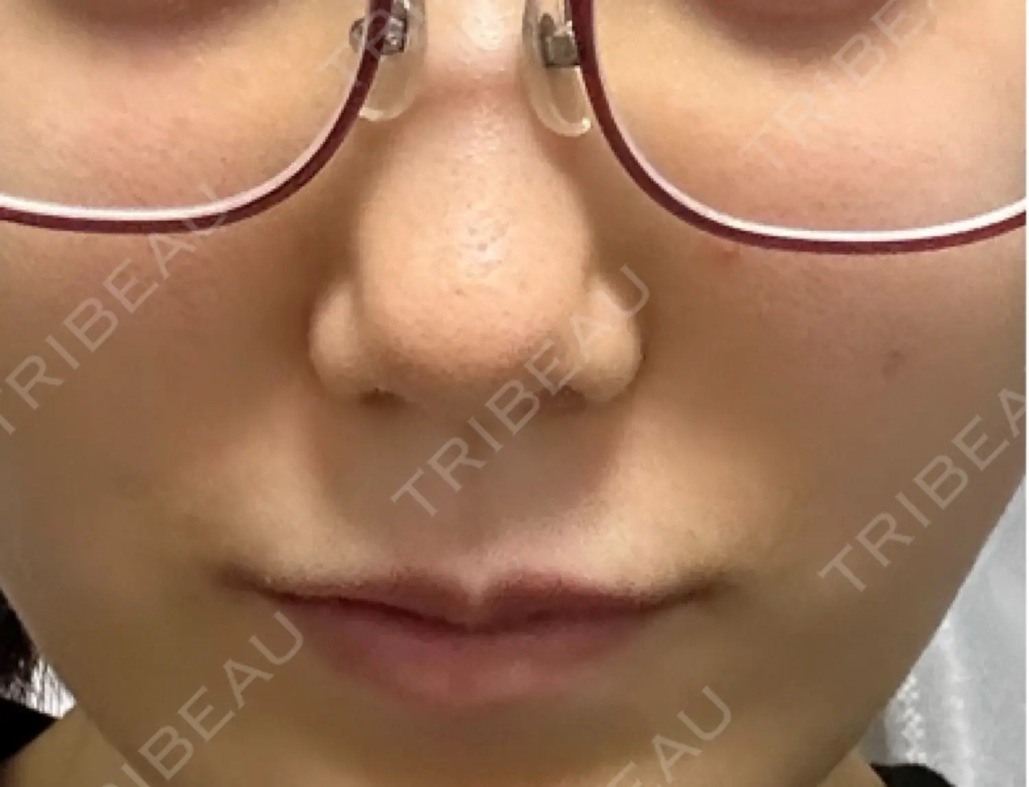 施術前の写真