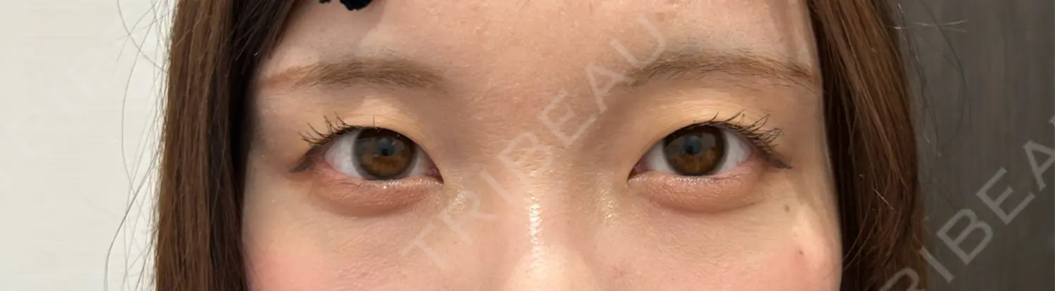 施術前の写真