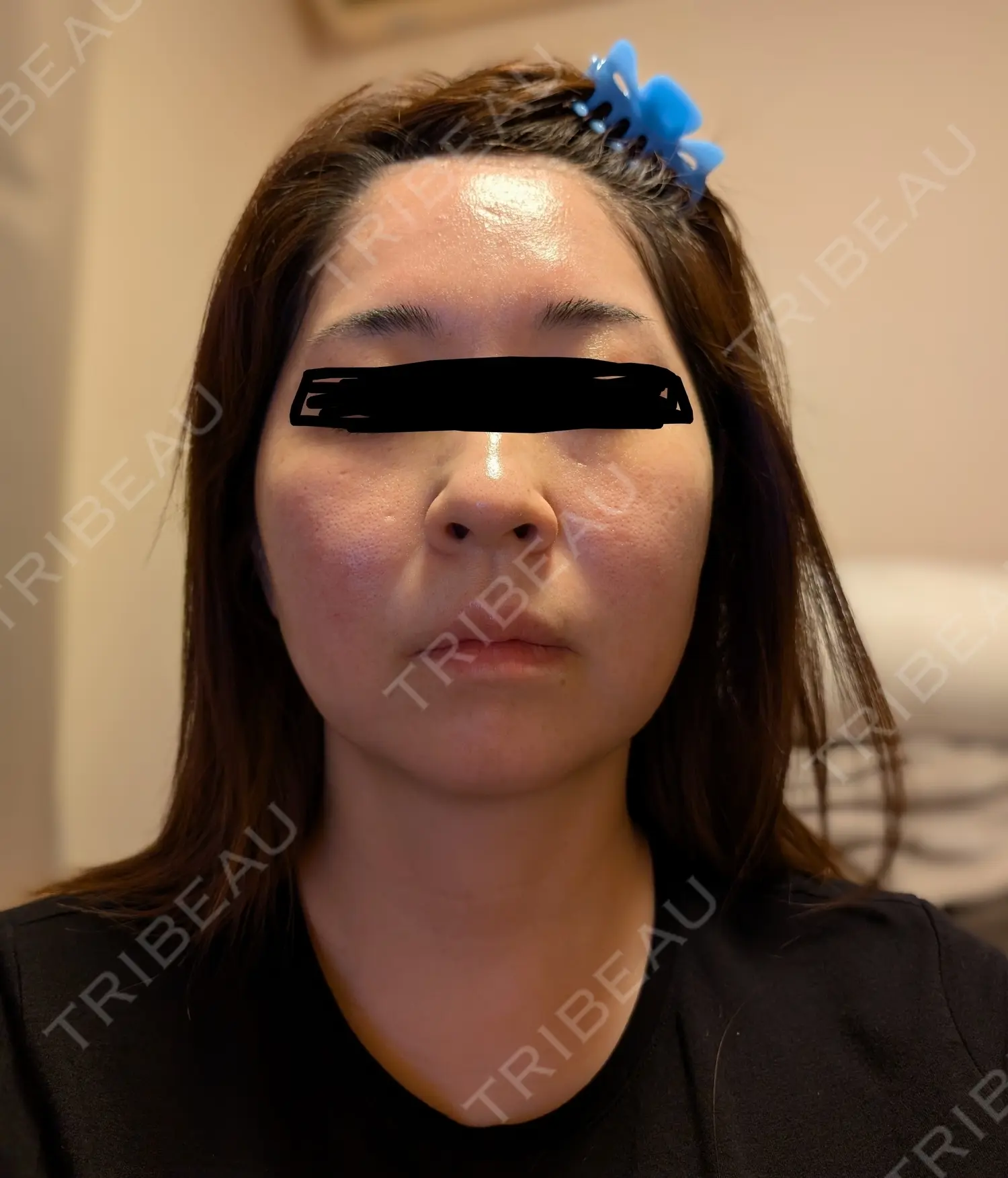 施術前の写真