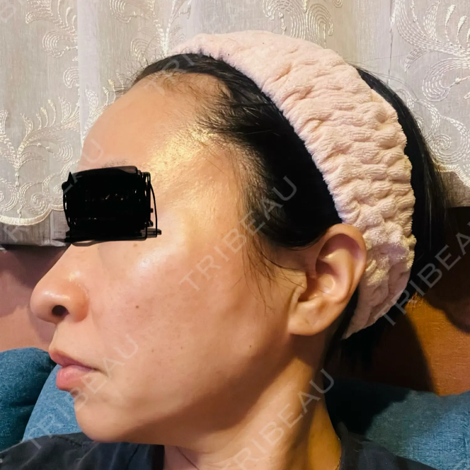 施術前の写真