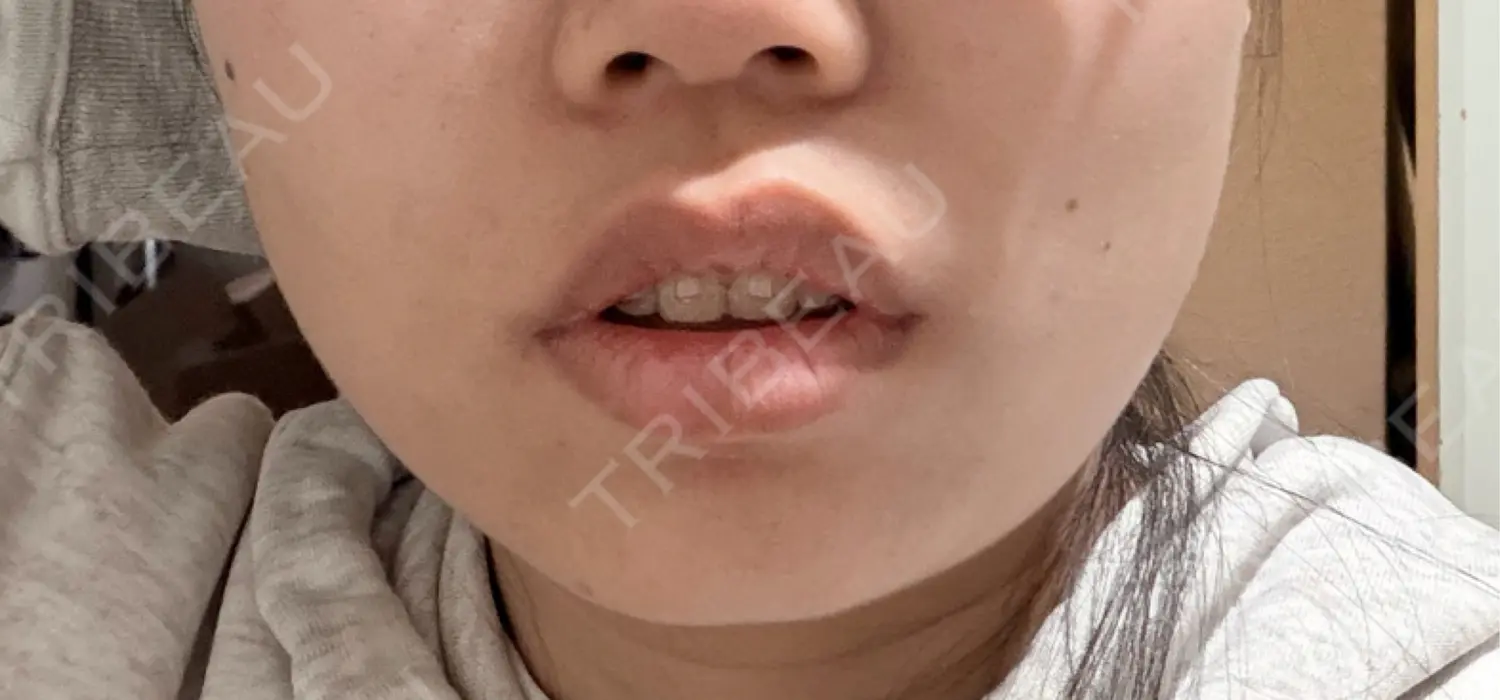 施術前の写真