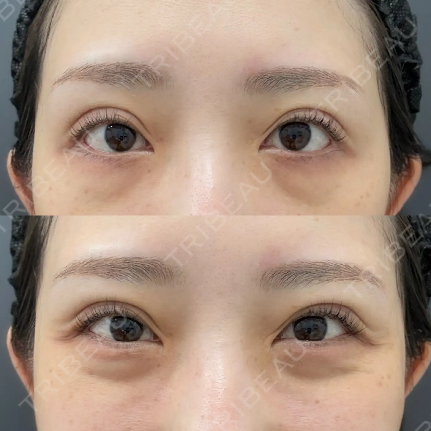 施術前の写真