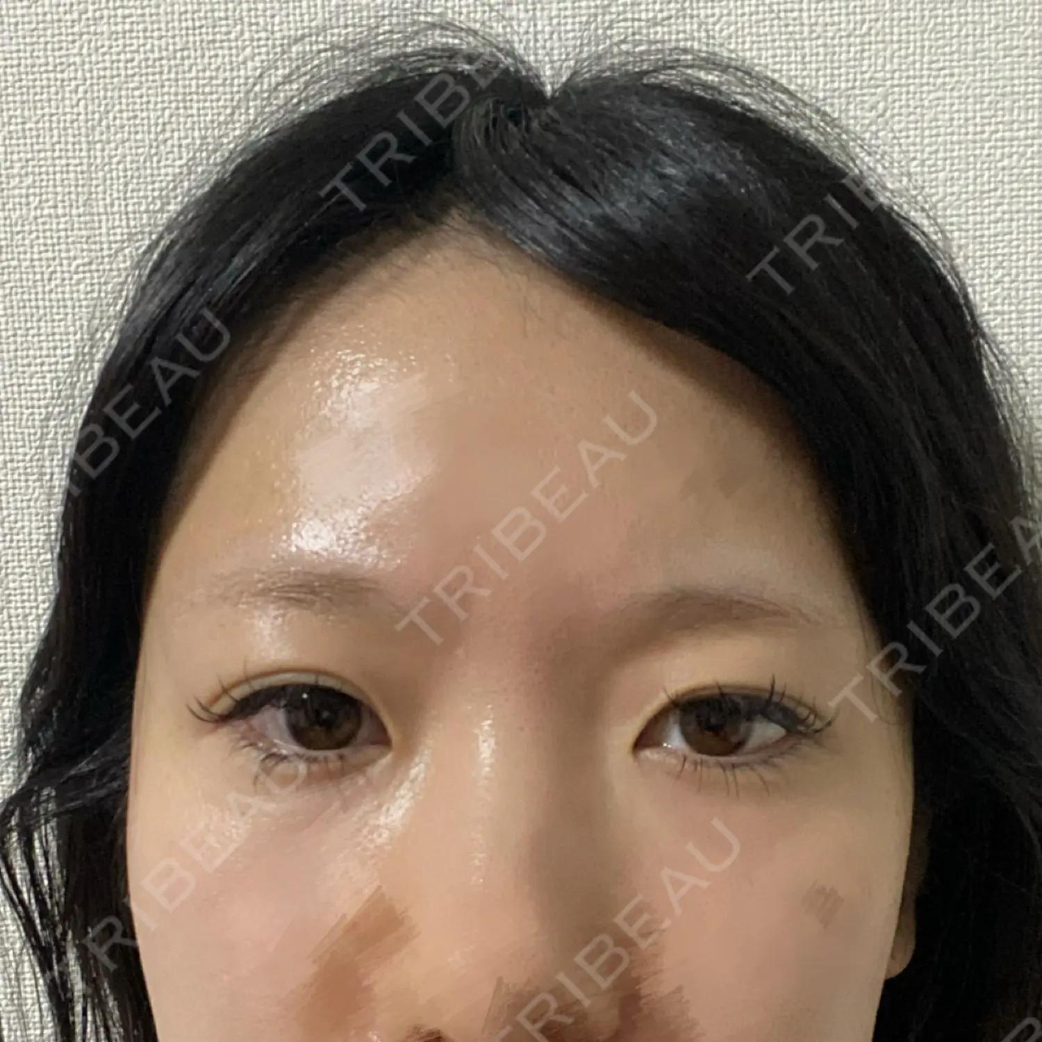 施術前の写真