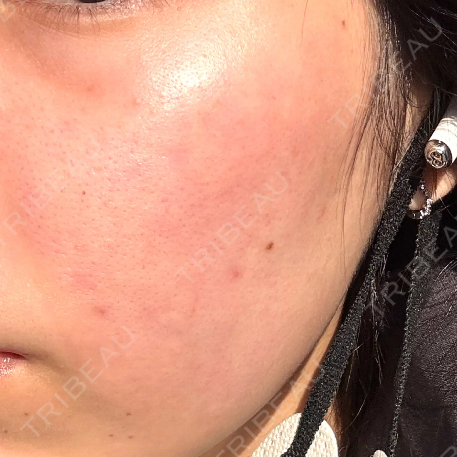 施術前の写真