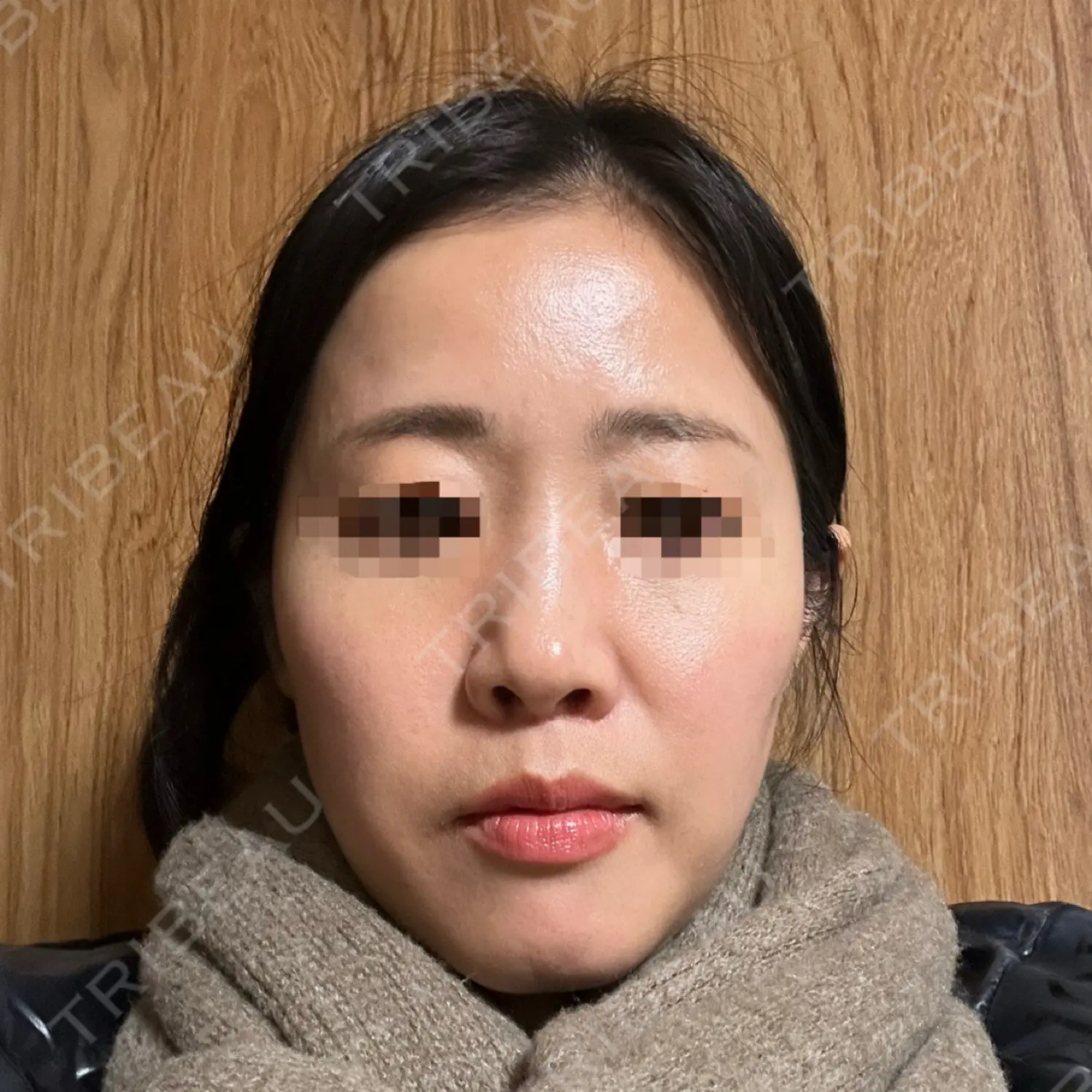 施術前の写真