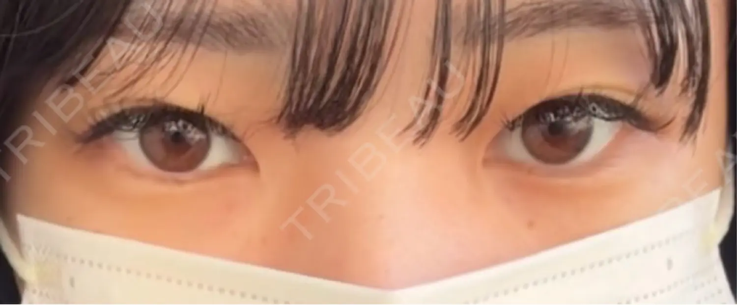 施術前の写真