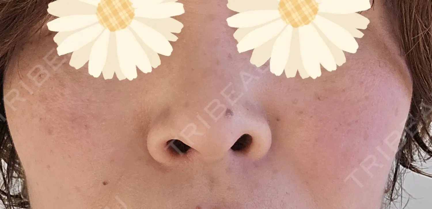 施術前の写真