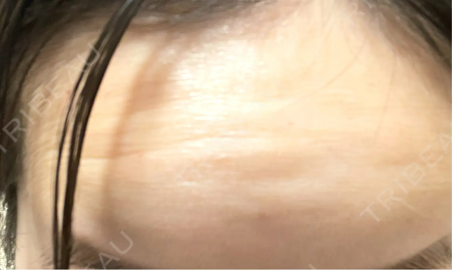 施術前の写真