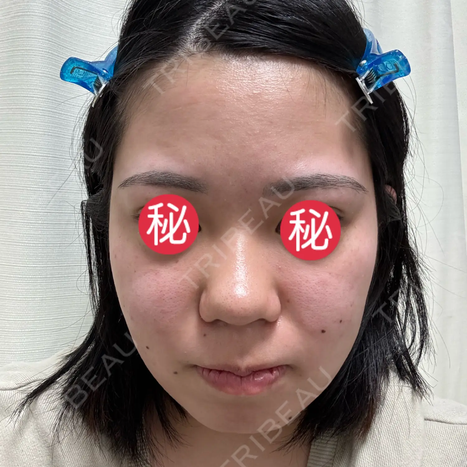 施術前の写真