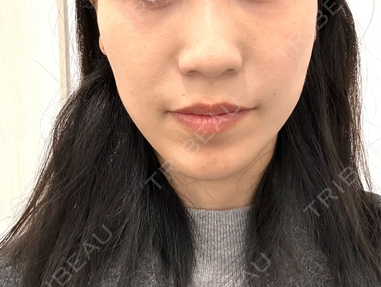 施術前の写真