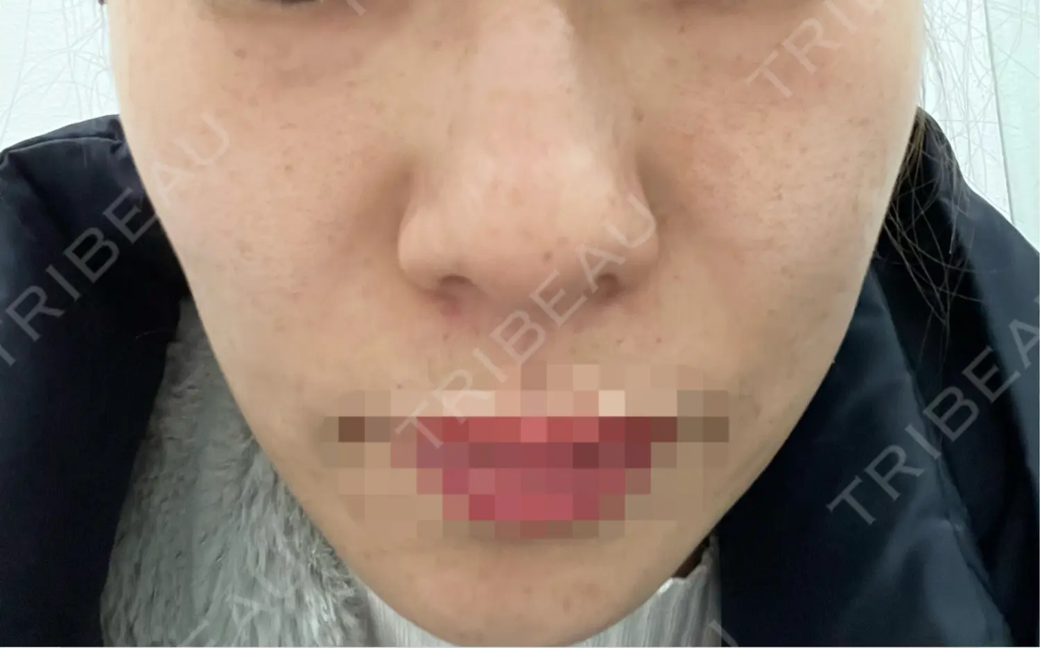 施術前の写真