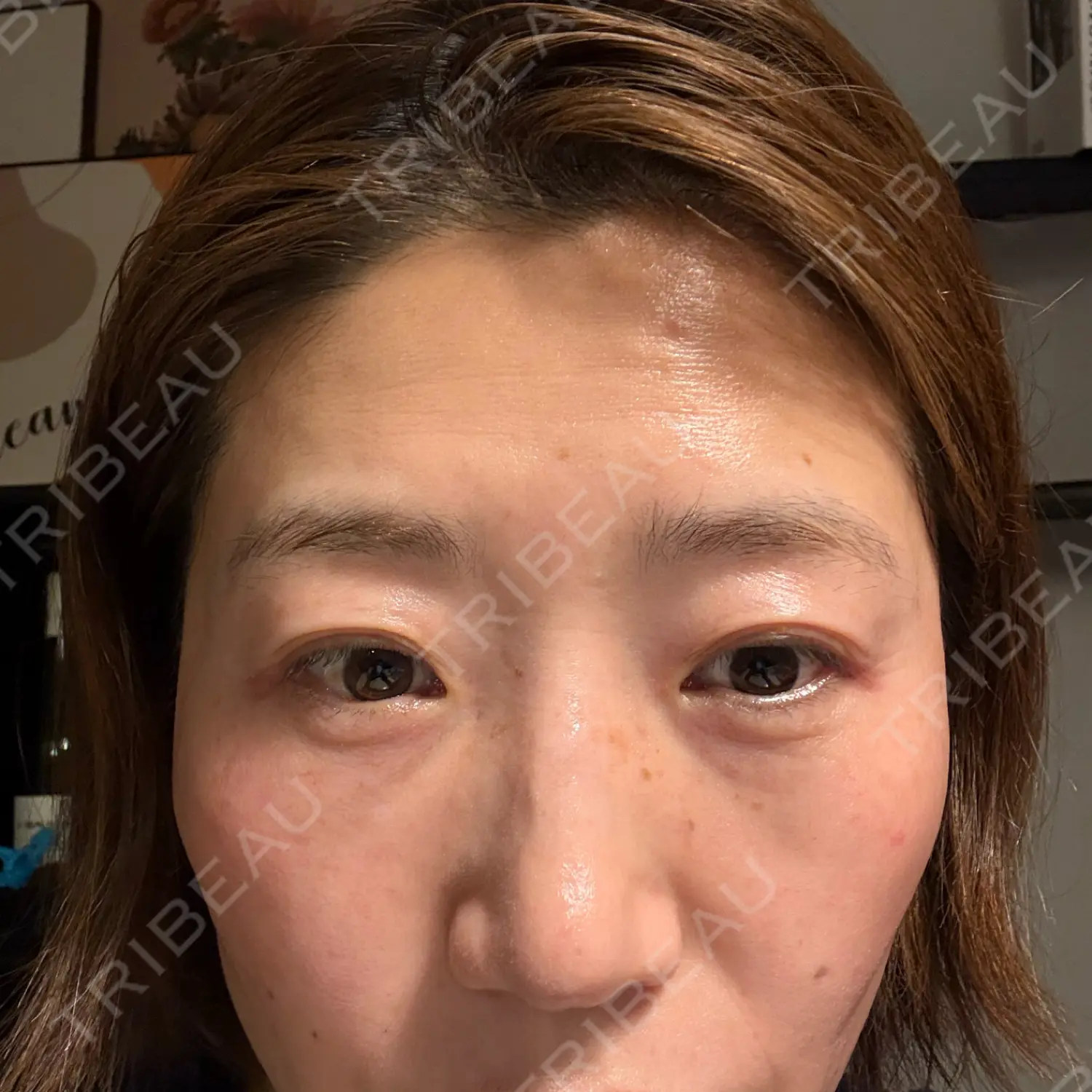 施術前の写真