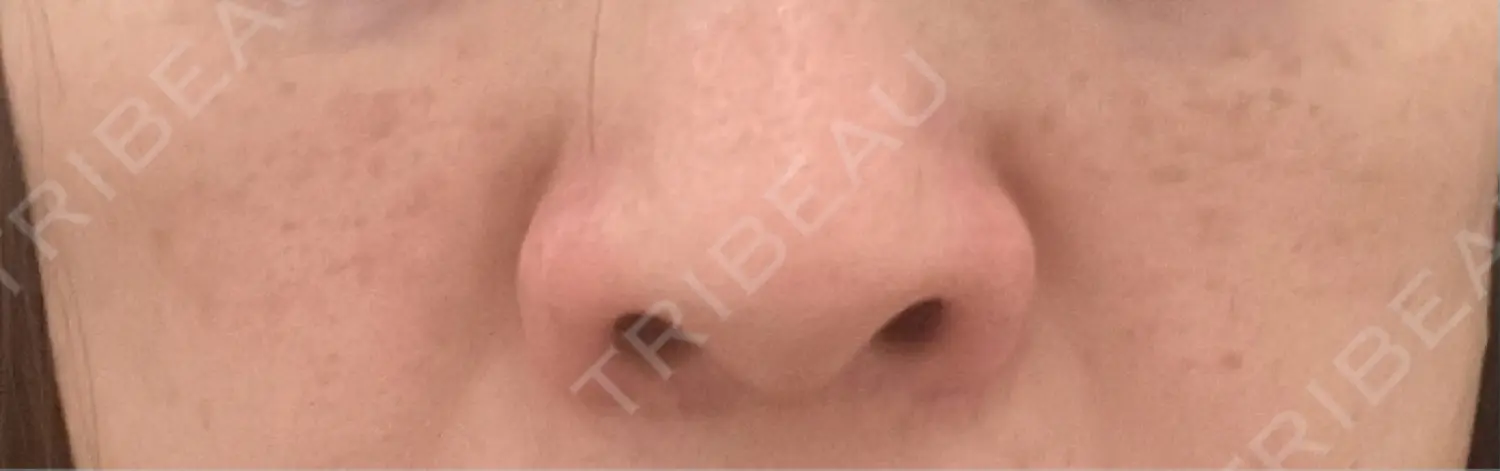 施術前の写真