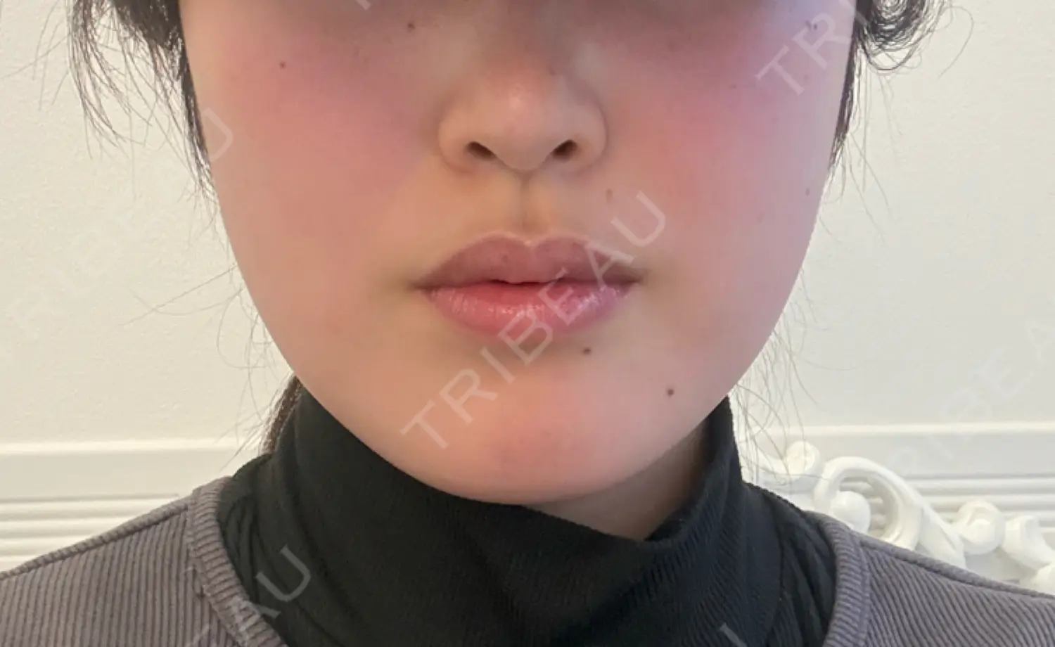 施術前の写真