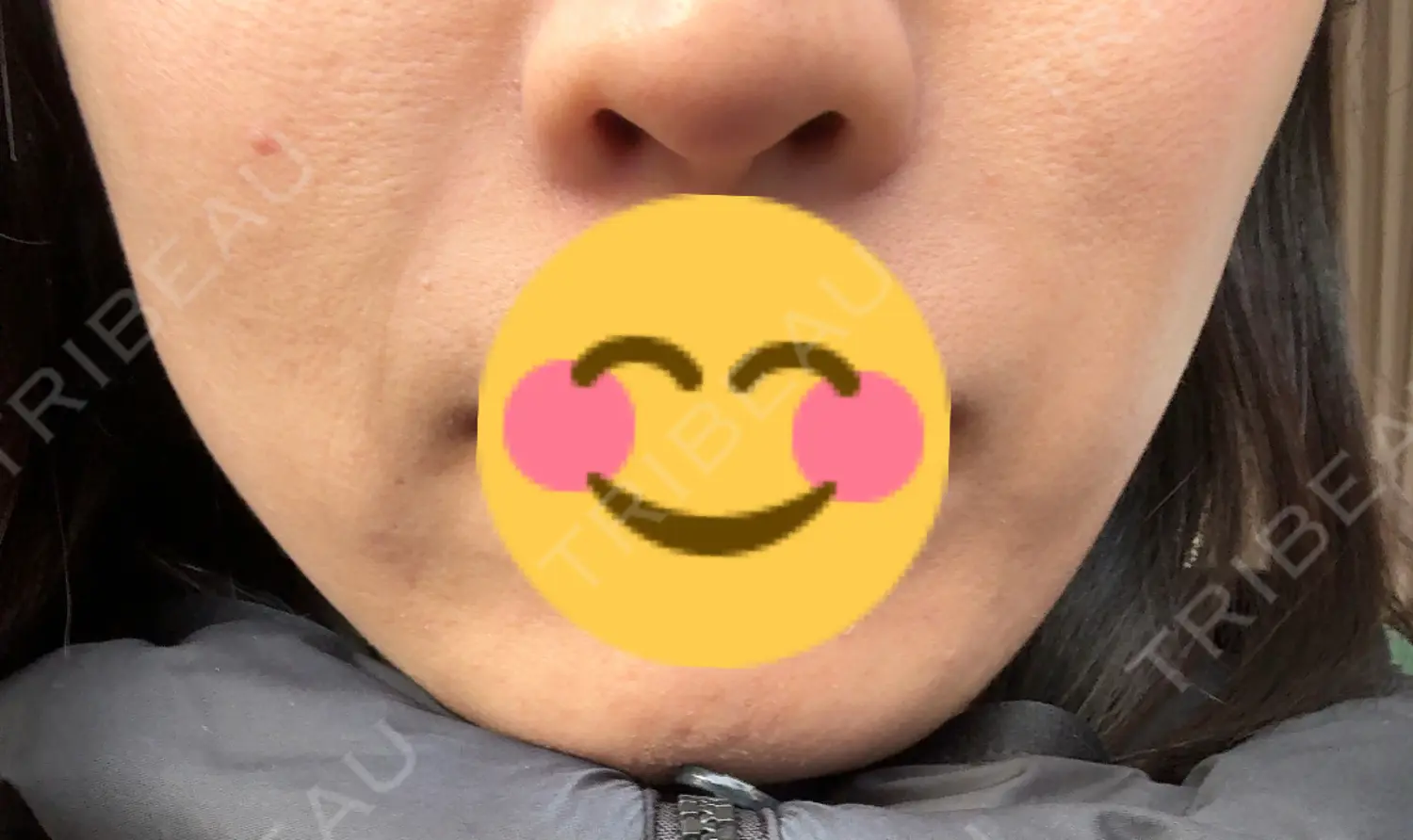 施術前の写真