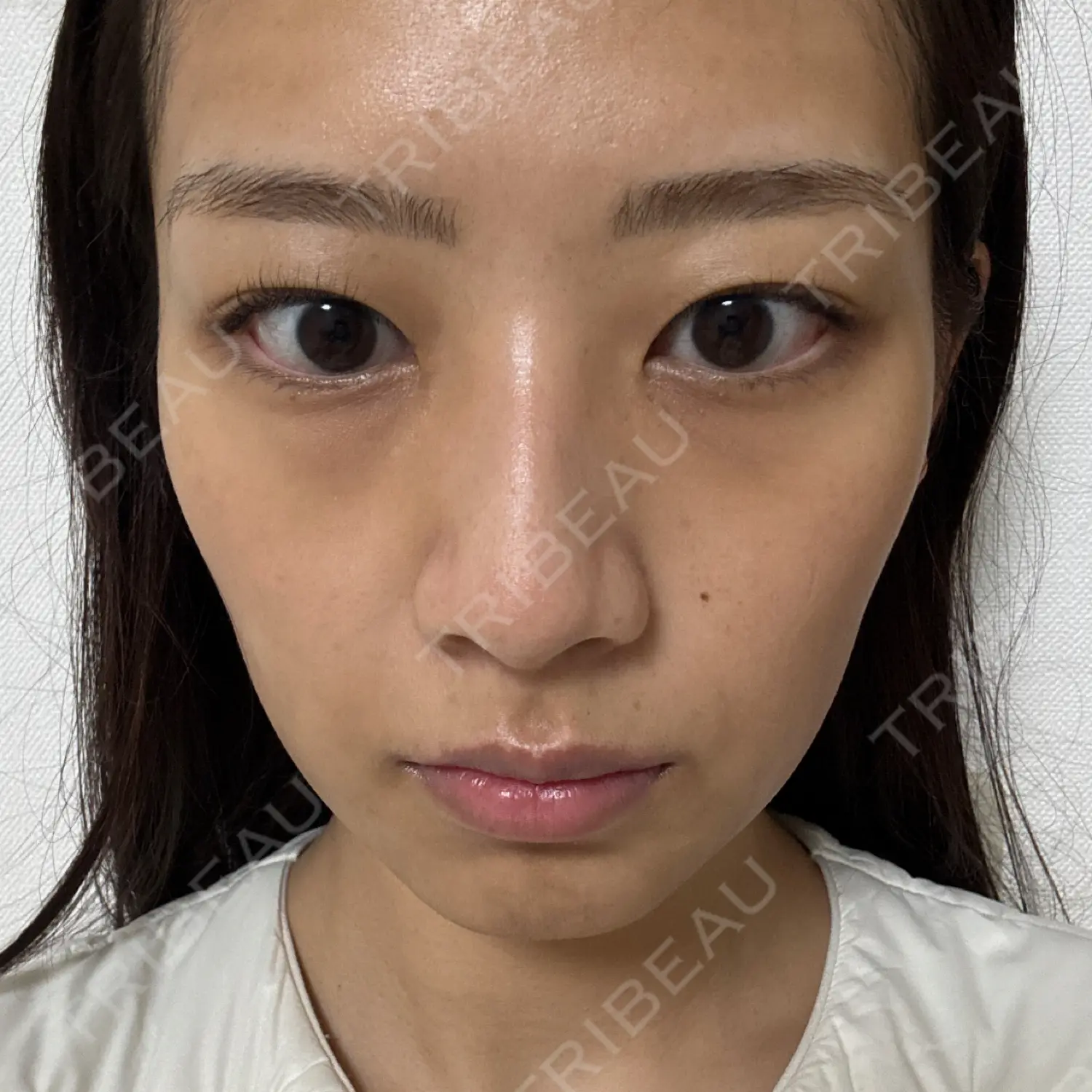 施術前の写真