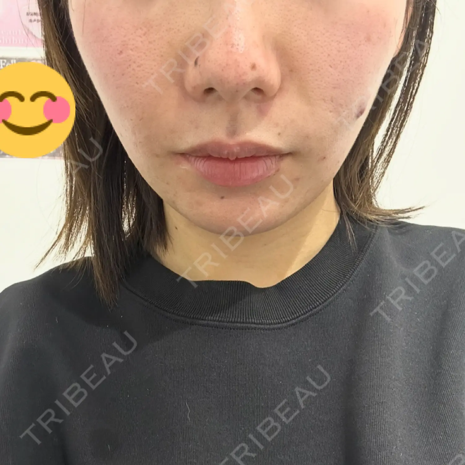 施術前の写真