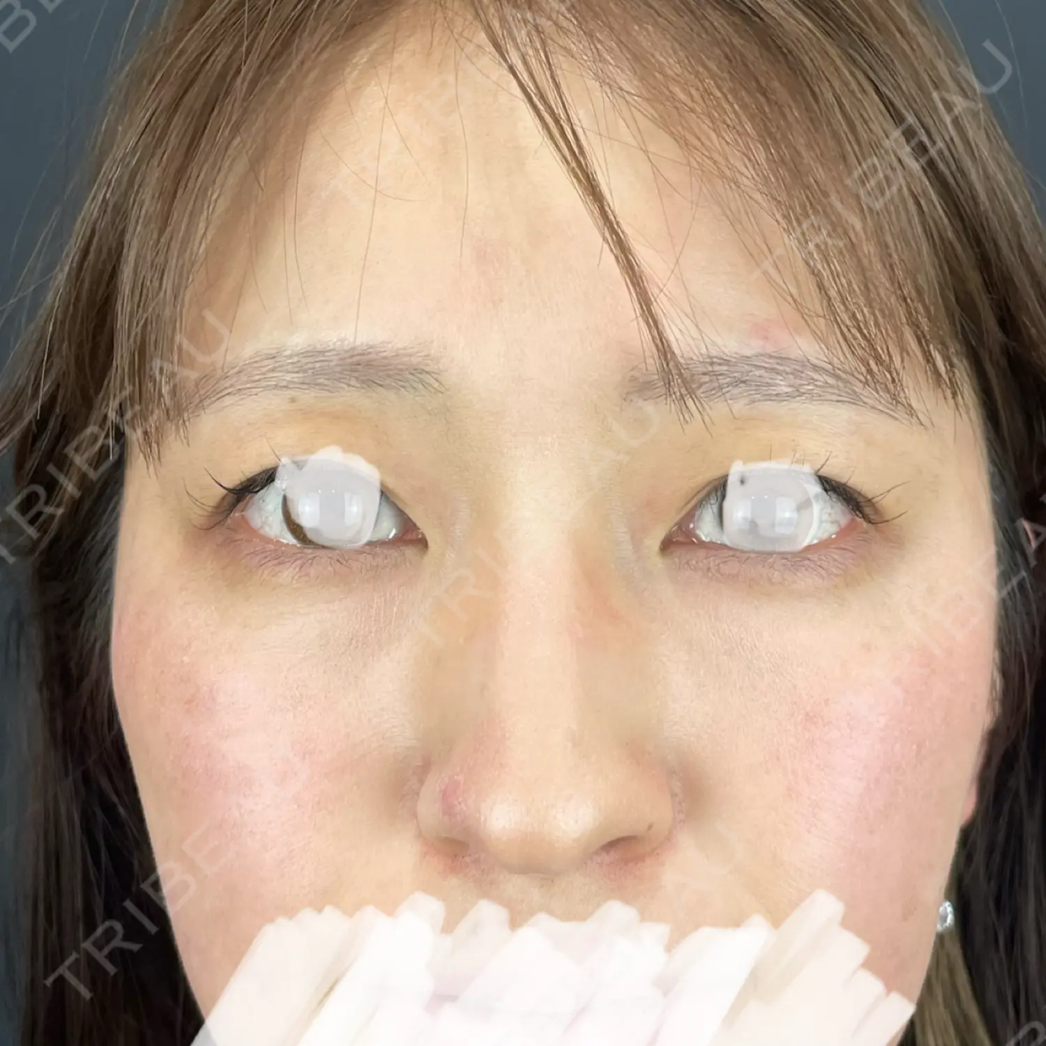 施術前の写真