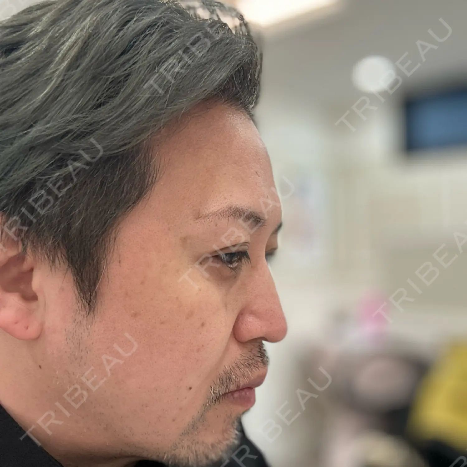 施術前の写真