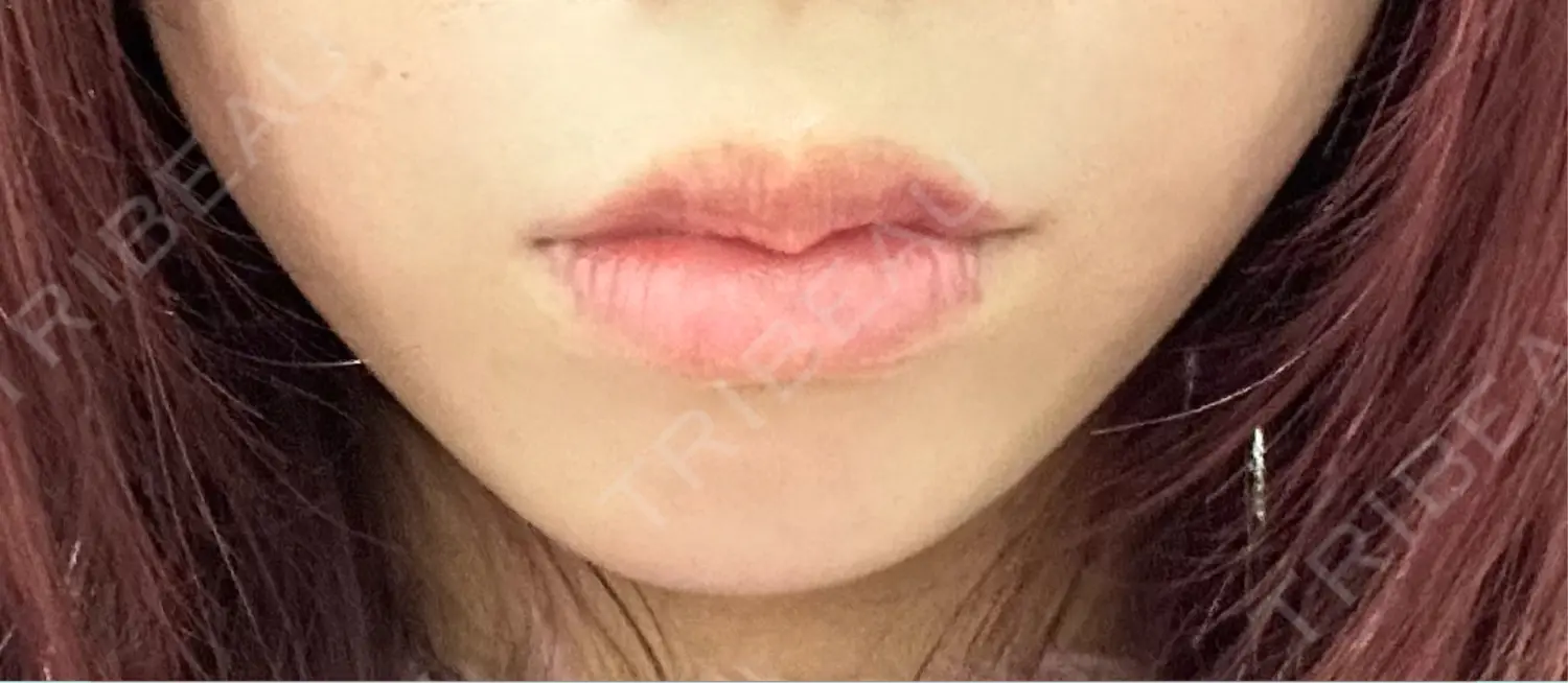 施術前の写真
