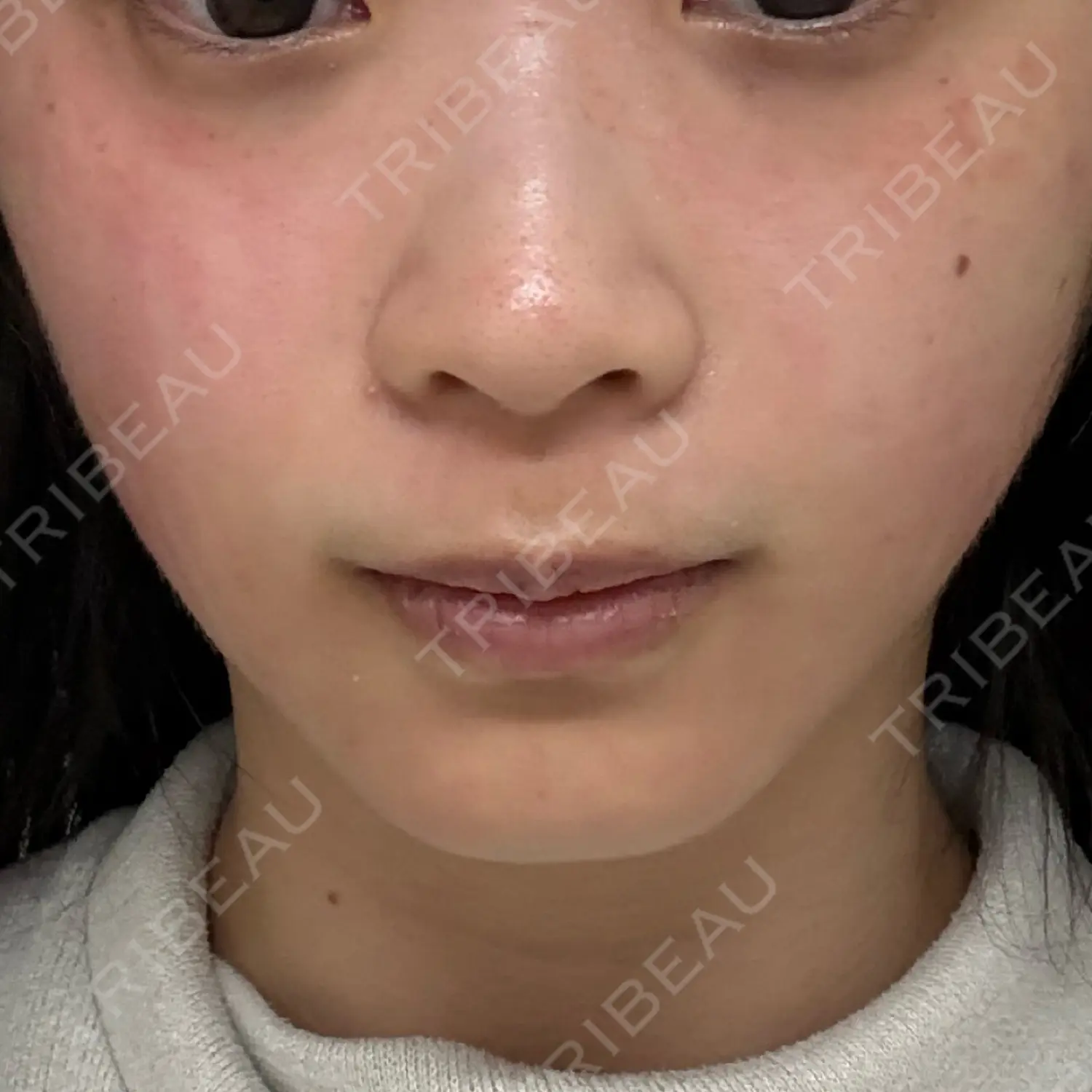 施術前の写真