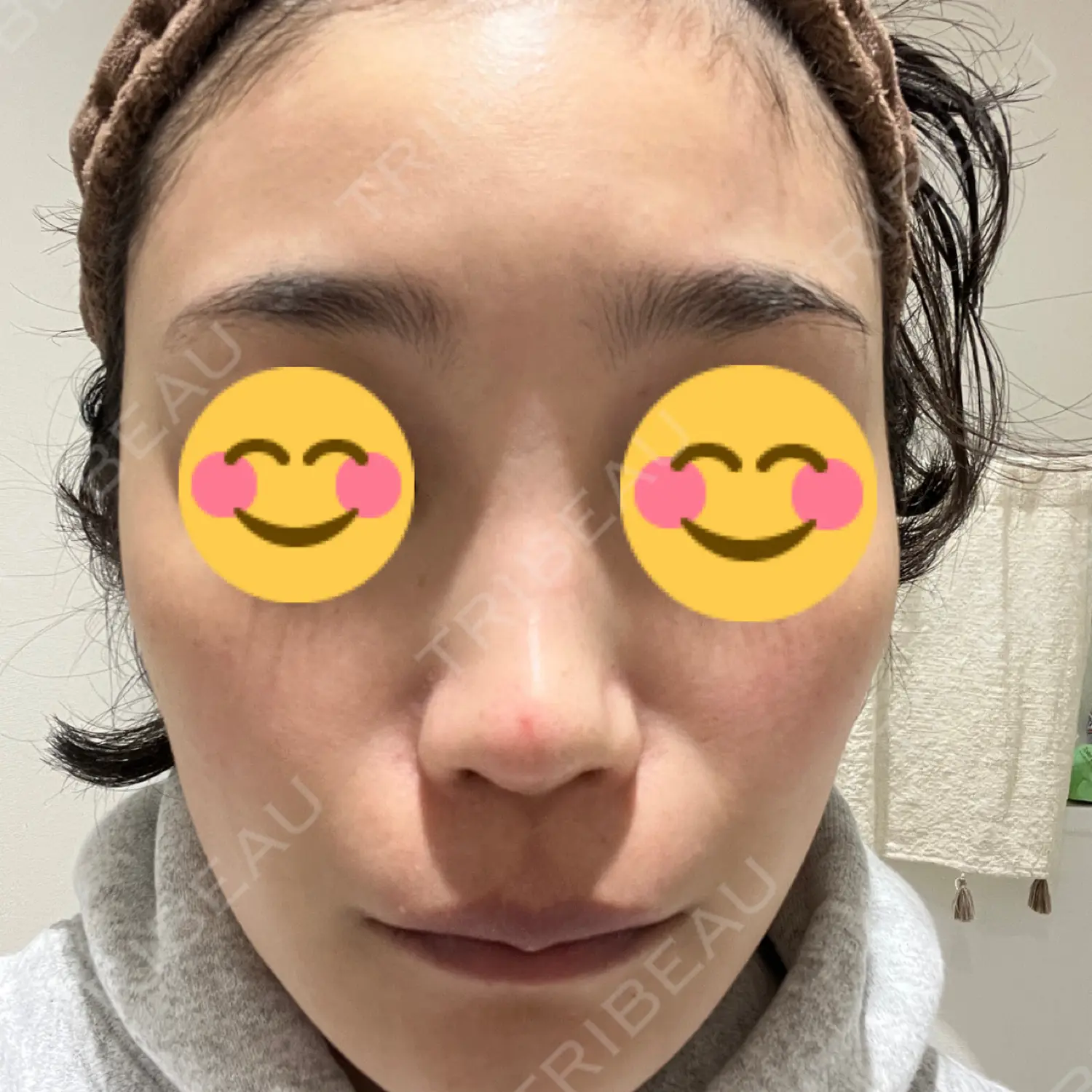 施術前の写真