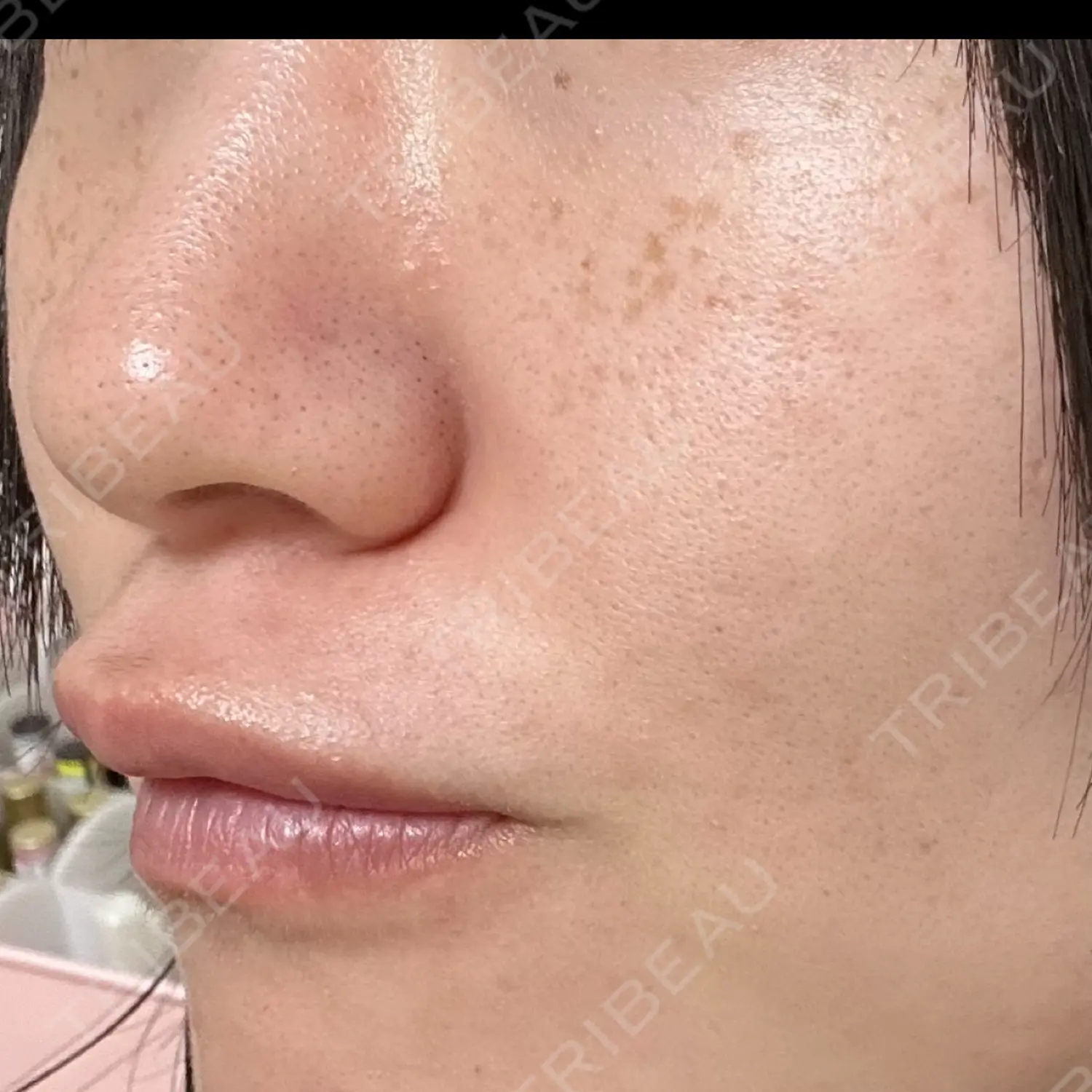 施術前の写真