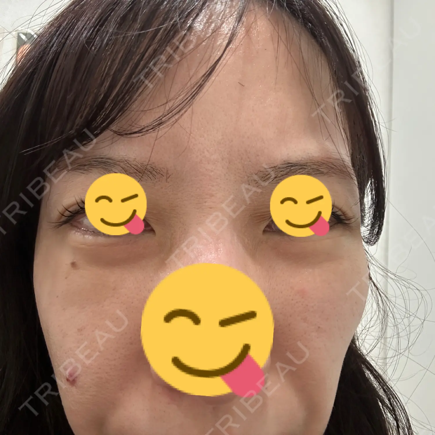 施術前の写真