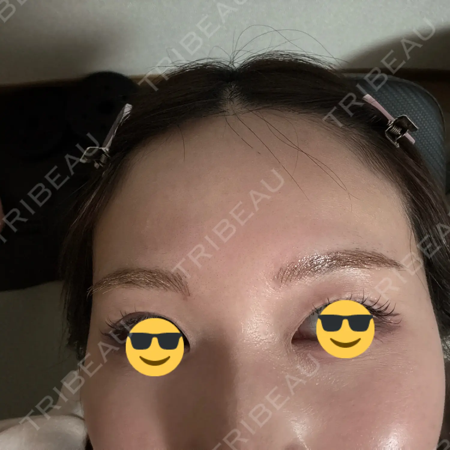 施術前の写真