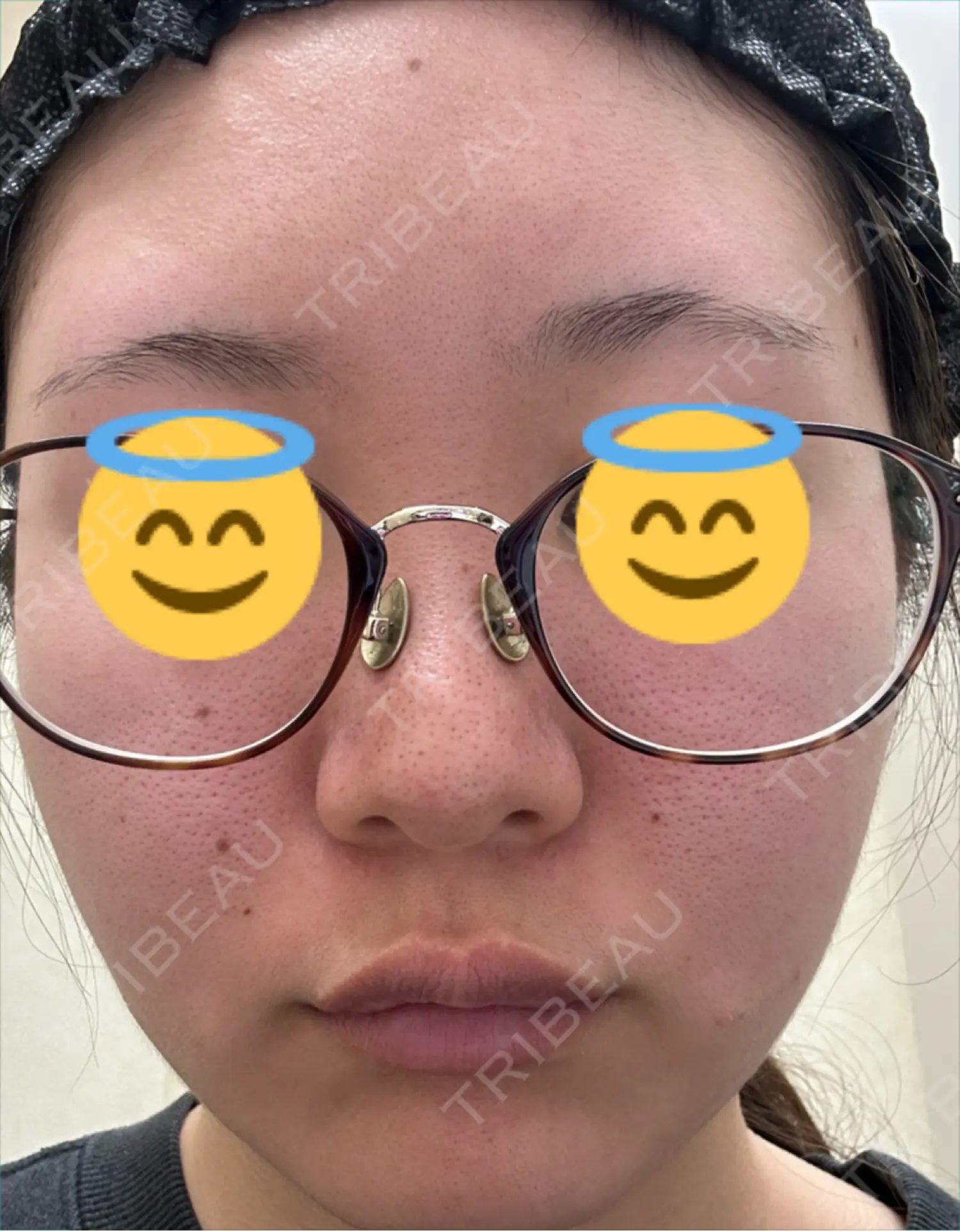 施術前の写真