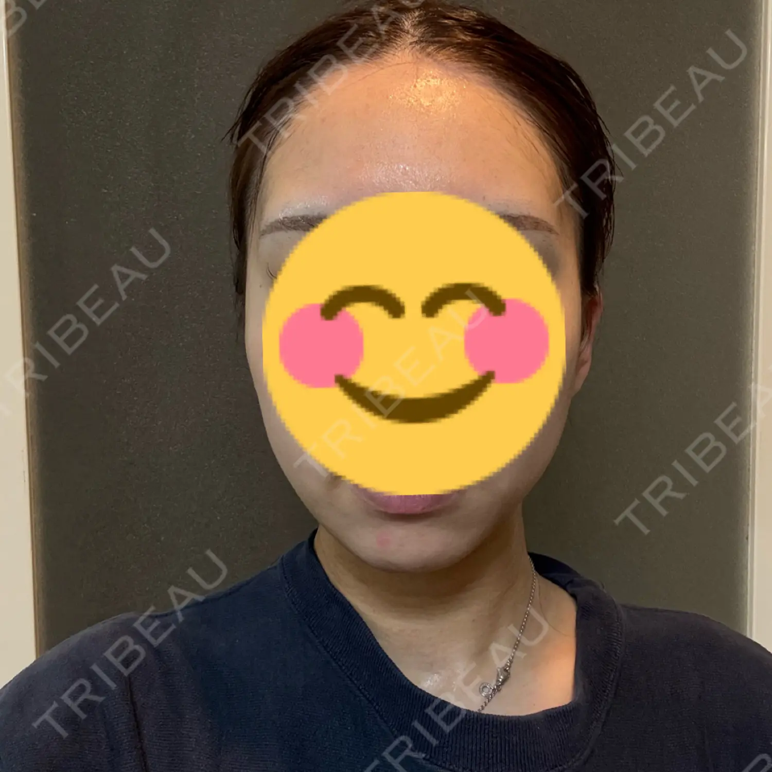 施術前の写真