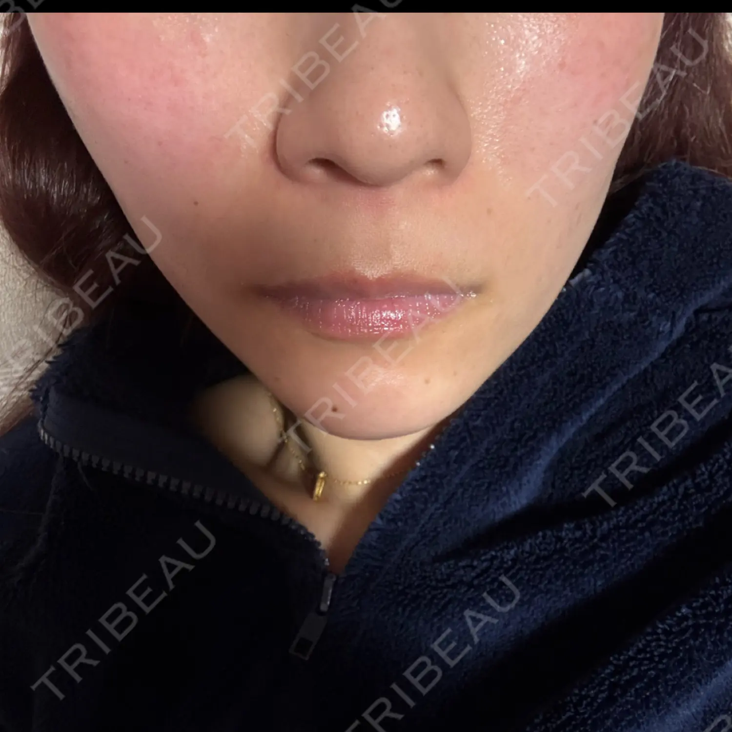 施術前の写真