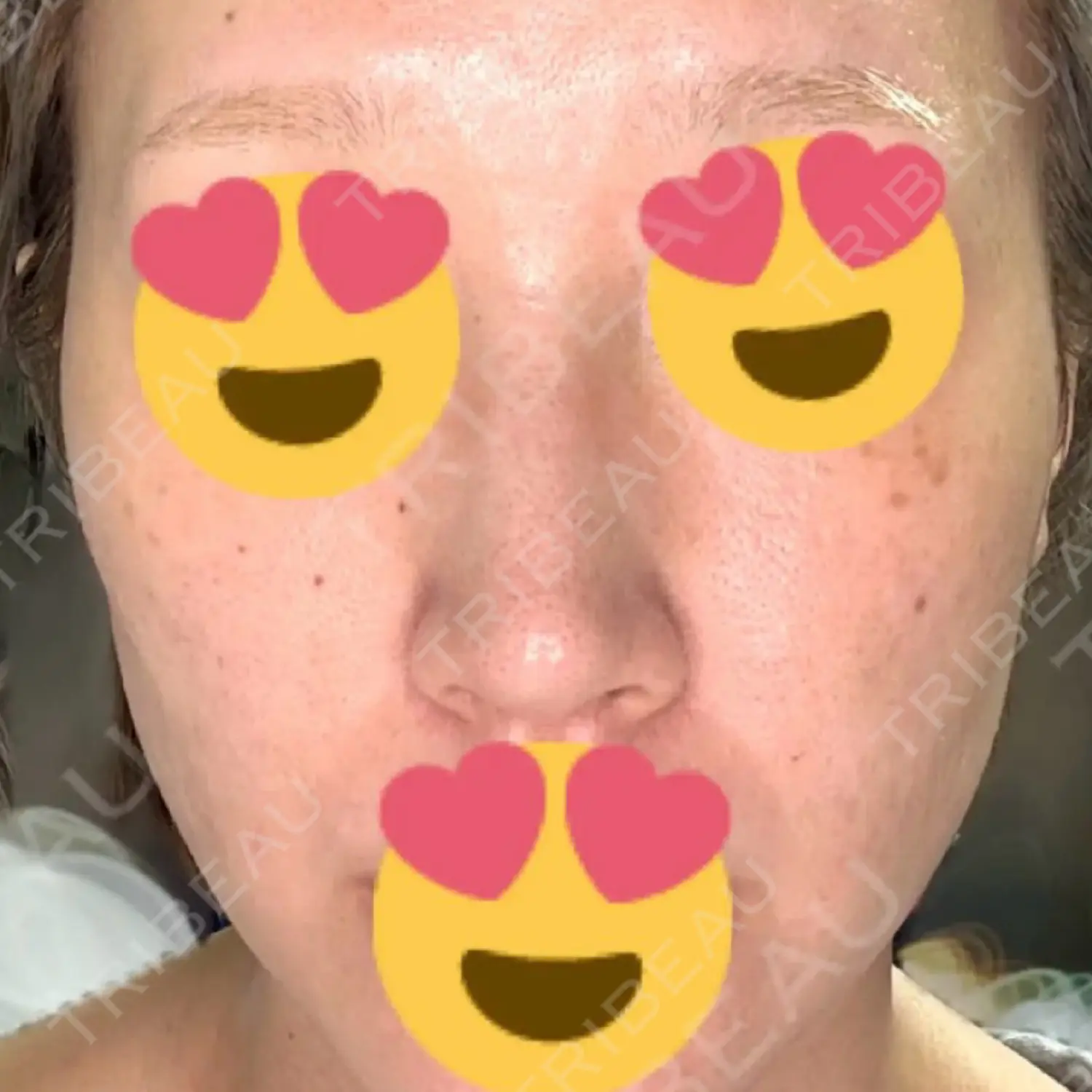 施術前の写真