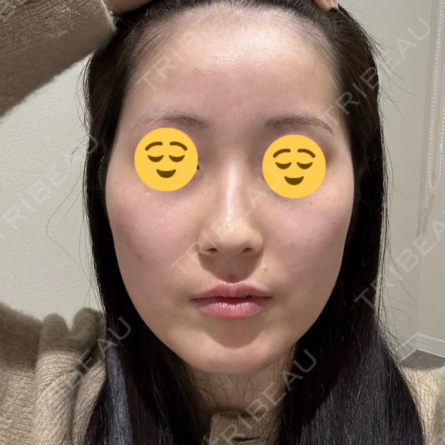 施術前の写真