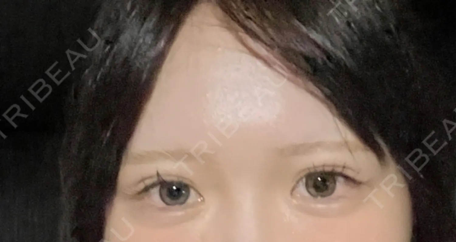 施術前の写真