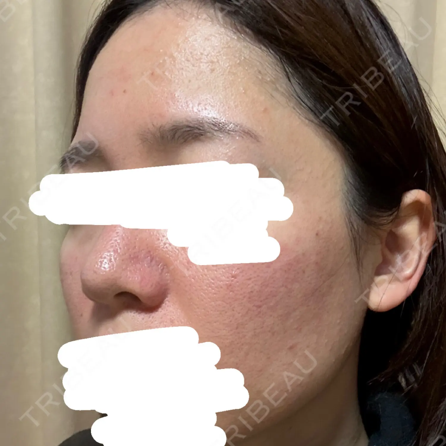 施術前の写真