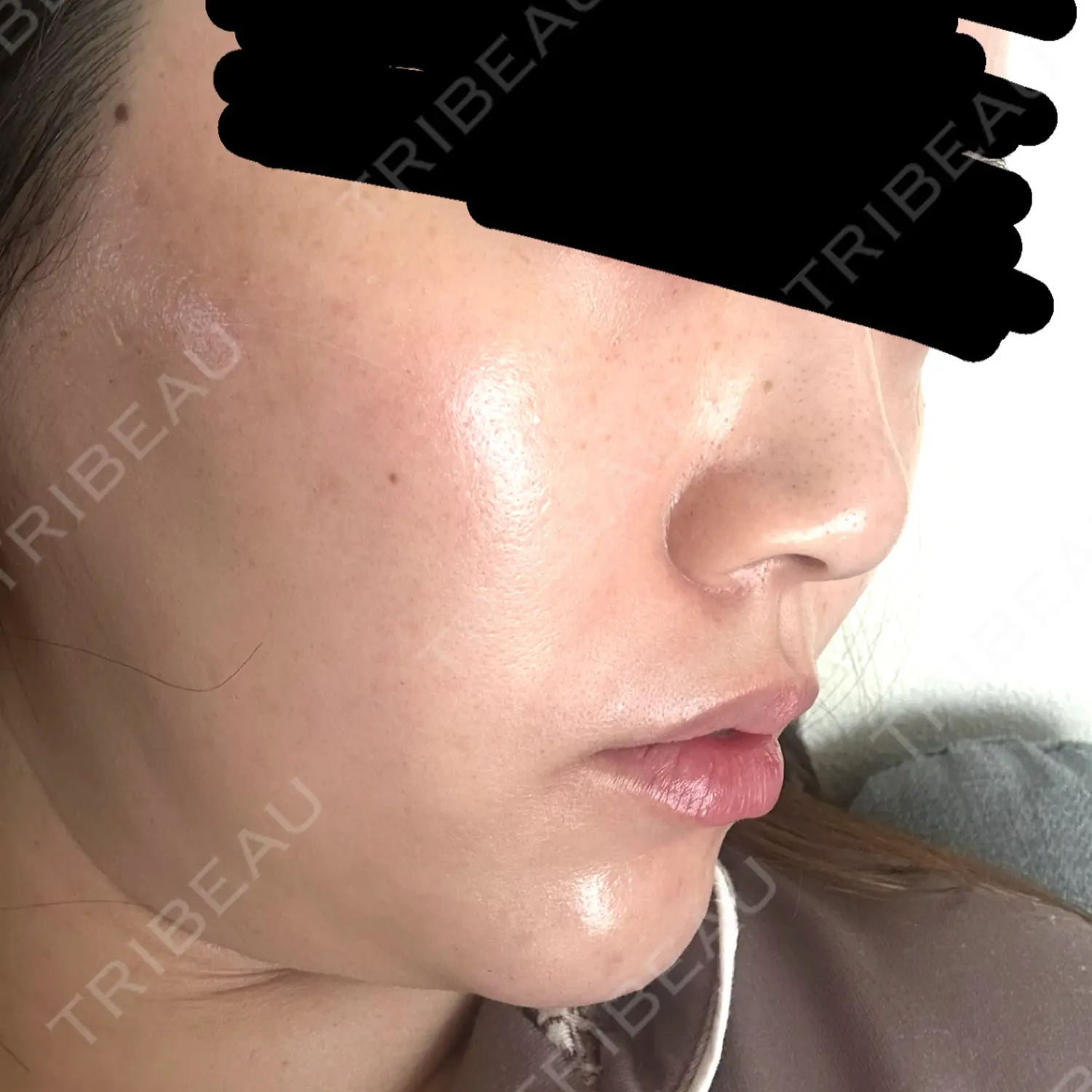 施術前の写真