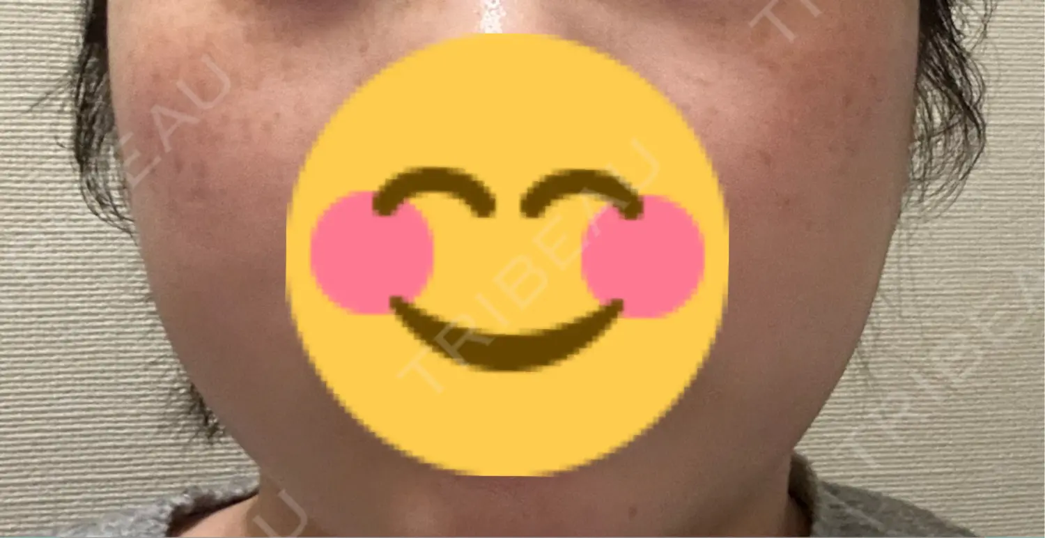 施術前の写真