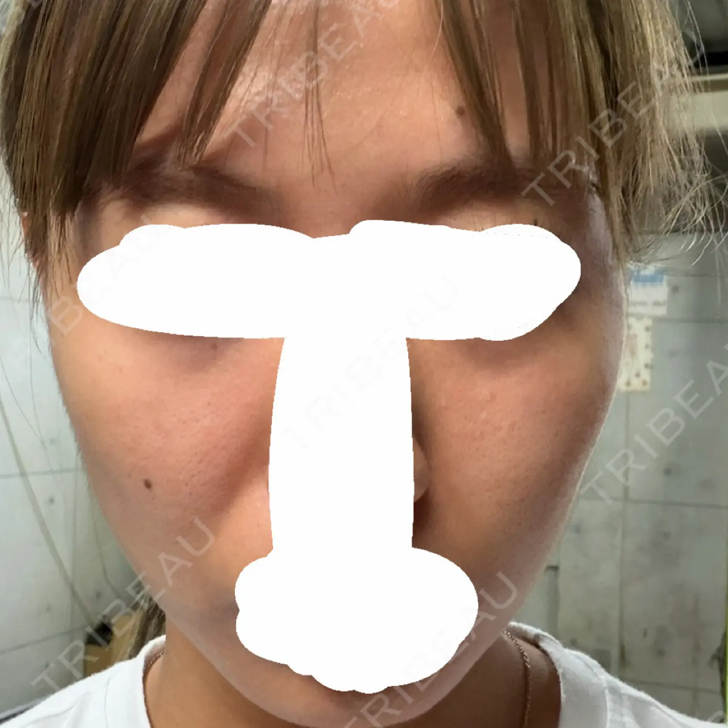 施術前の写真