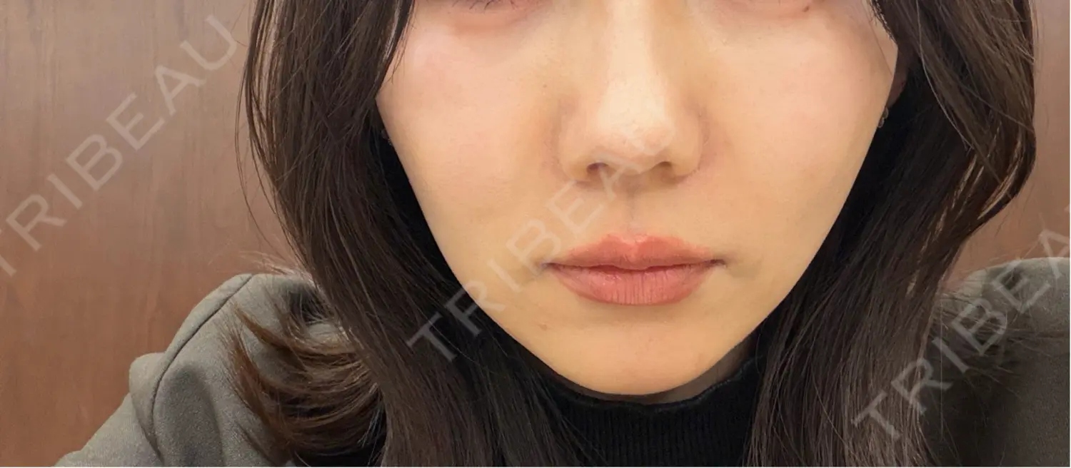 施術前の写真