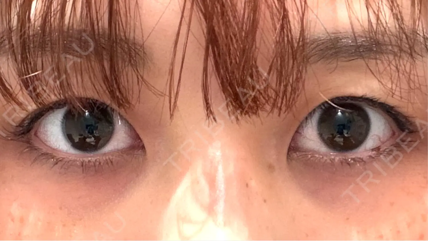 施術前の写真