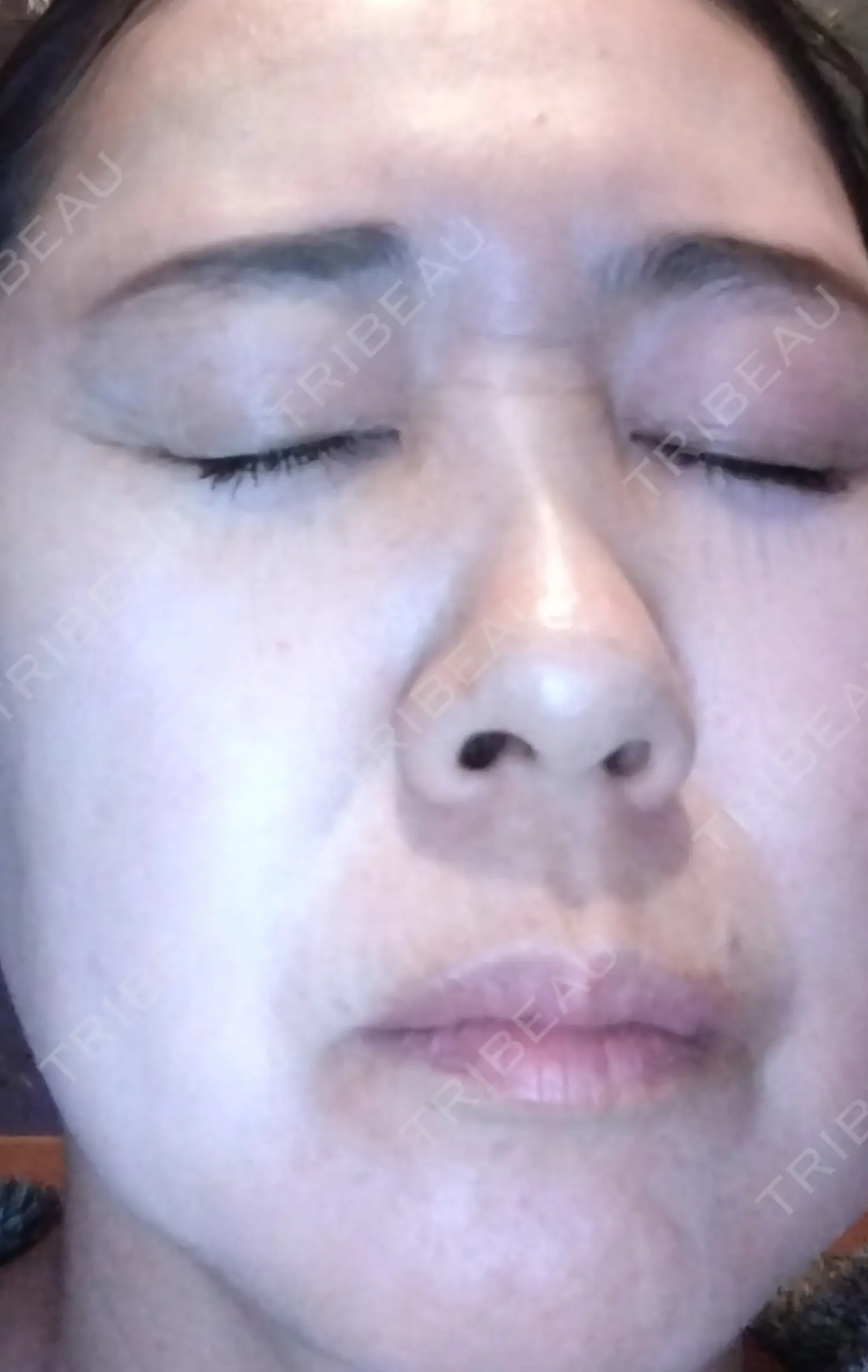 施術前の写真