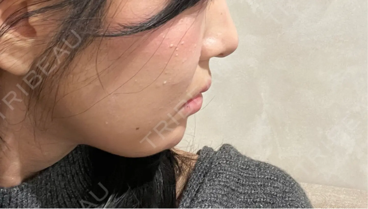 施術前の写真