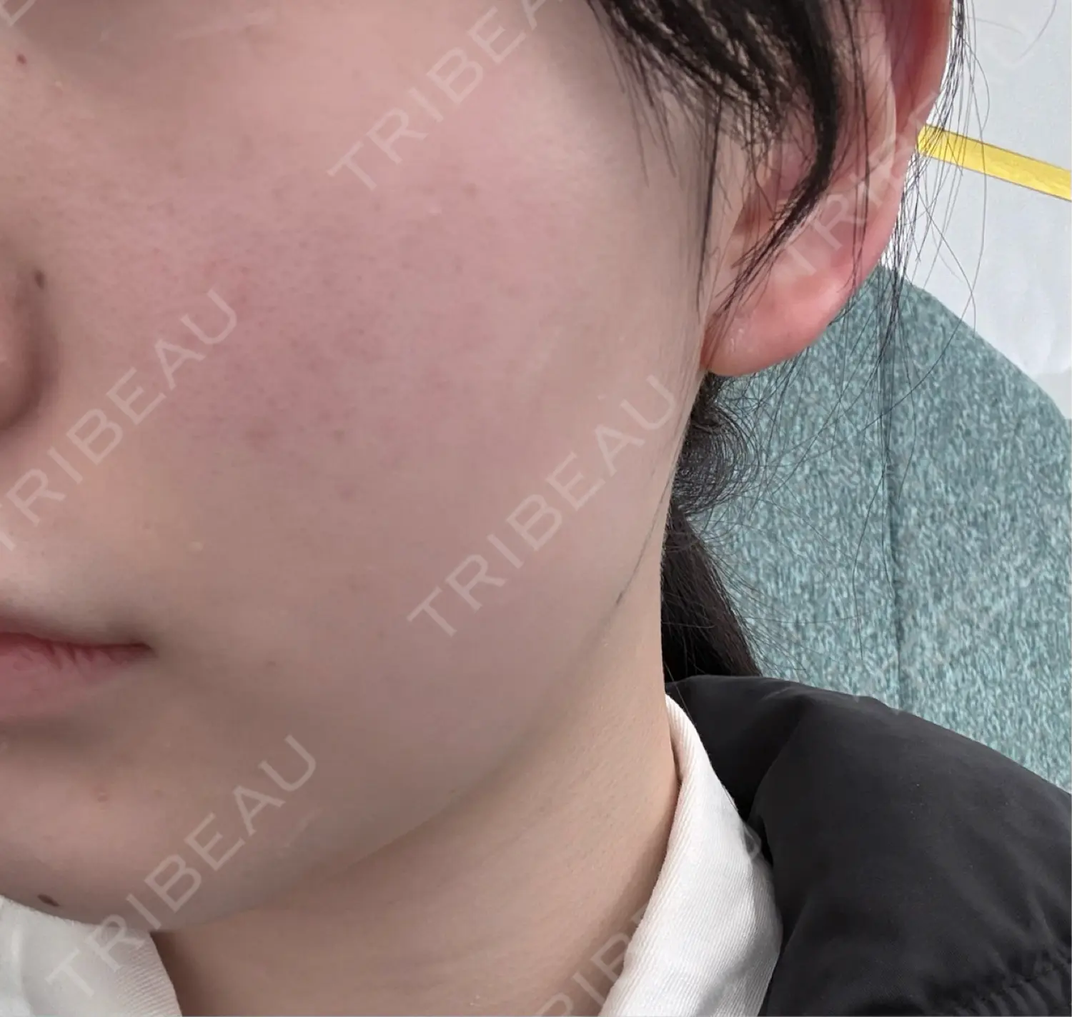 施術前の写真