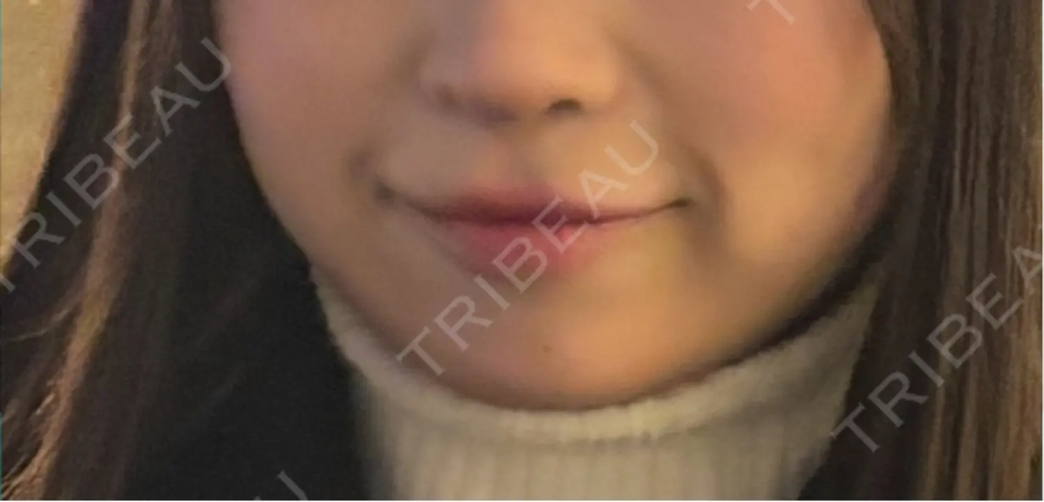 施術前の写真