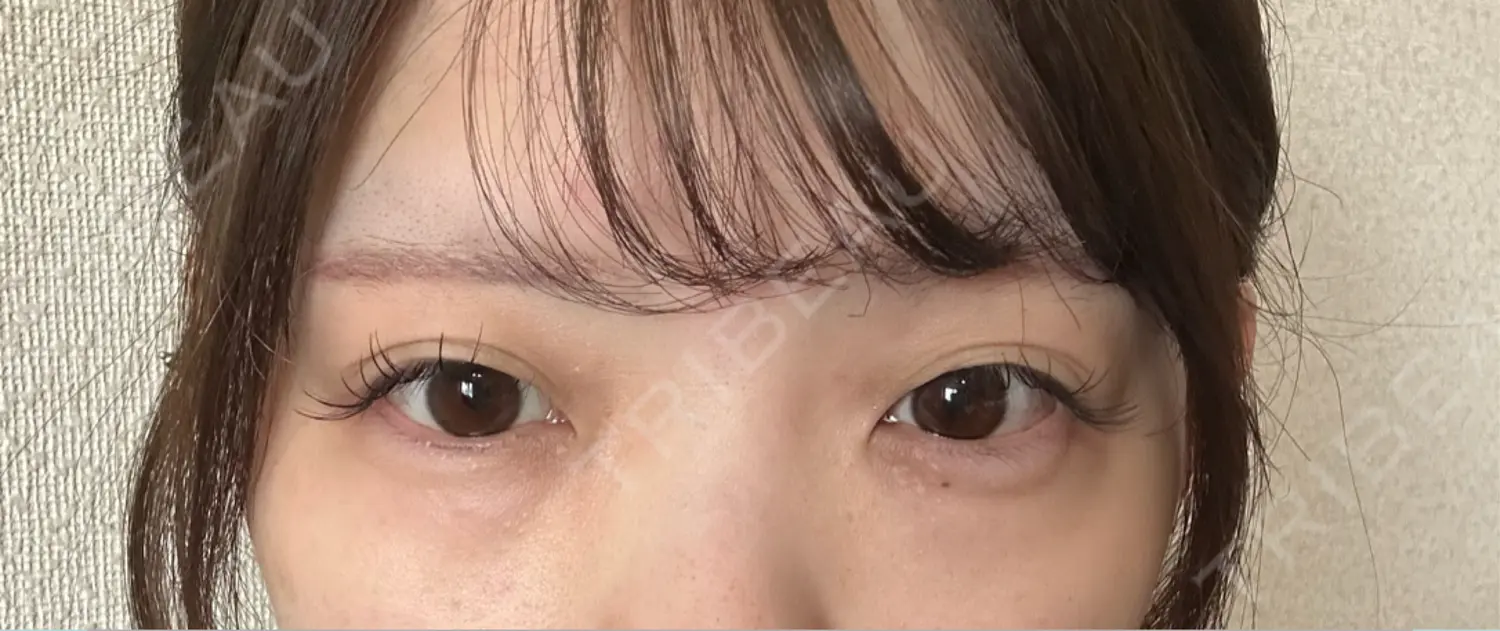 施術前の写真