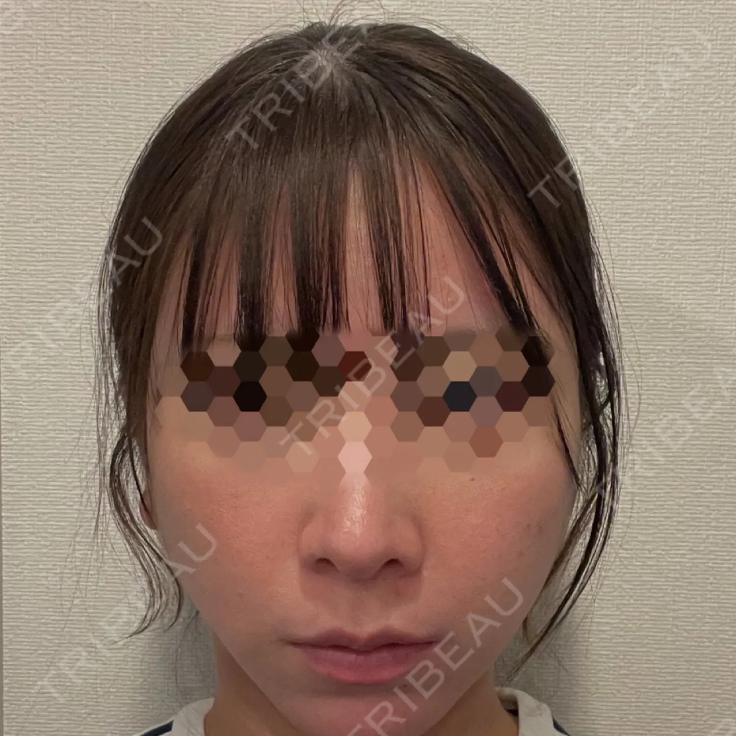 施術前の写真